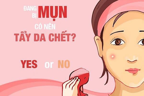 Da mụn có nên tẩy tế bào chết không?