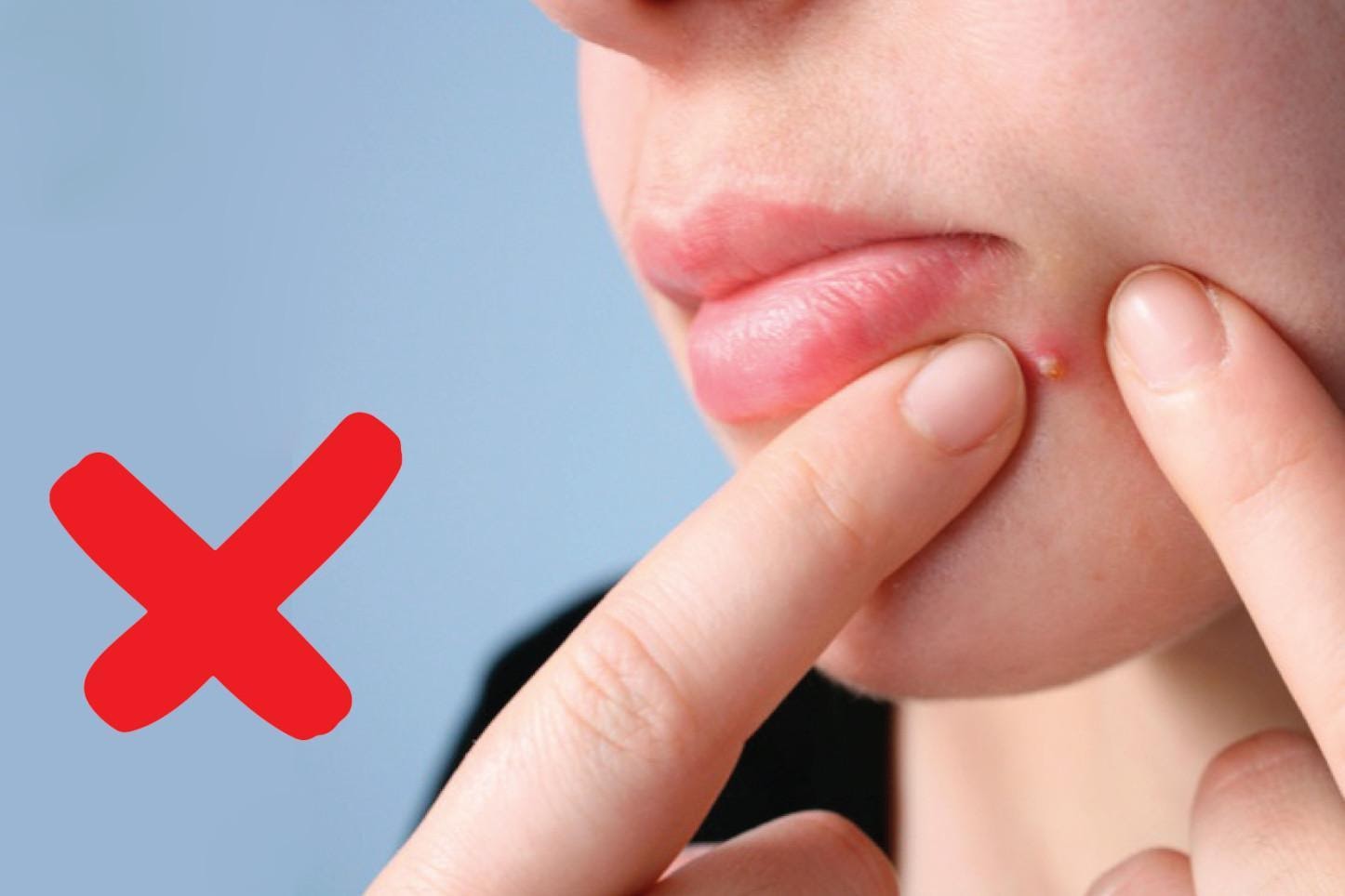 4 nguyên tắc giúp bạn trị mụn thành công