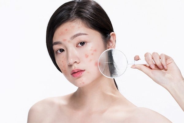 Mụn là gì? Nguyên nhân hình thành mụn, có bao nhiêu loại mụn trứng cá