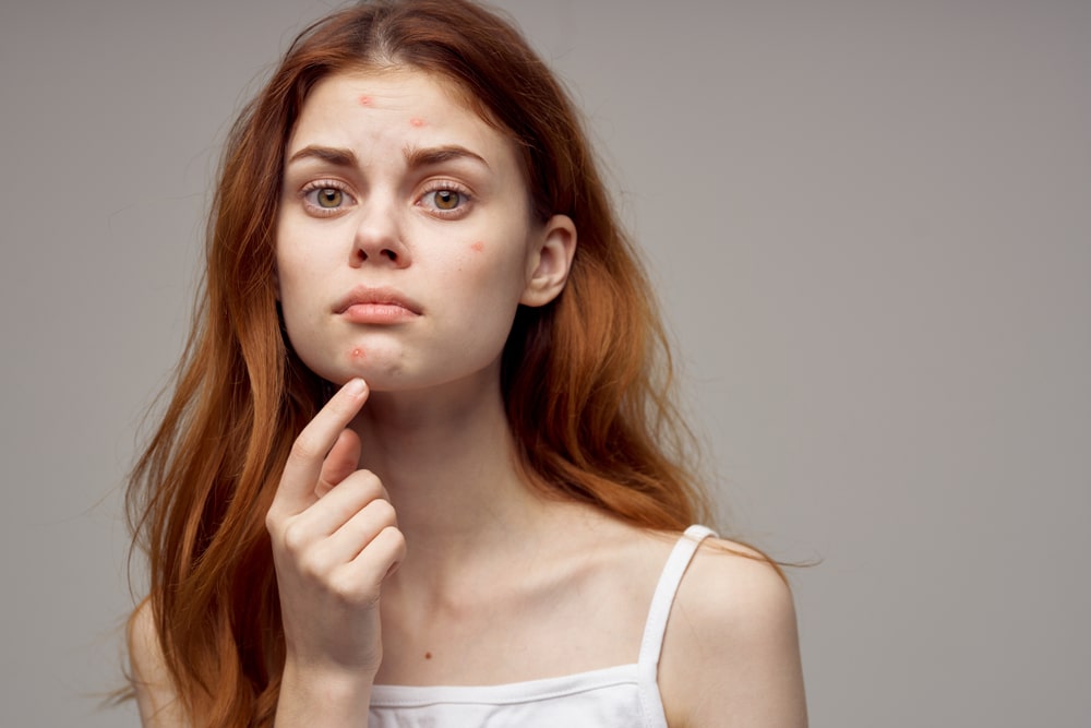 Top 5 serum trị thâm mụn hiệu quả được tin dùng