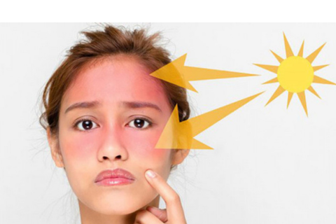 Dấu hiệu nhận biết da bị cháy nắng và chăm sóc da bị cháy nắng như thế nào ?