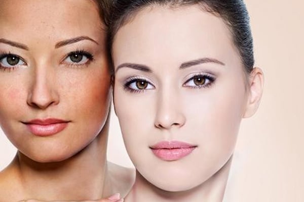 10 loại kem trị nám tốt nhất 2021 - Hết nám, da sáng mịn