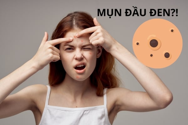 Chinh Phục Mụn Đầu Đen: Hành Trình Cải Thiện Da Từ A đến Z