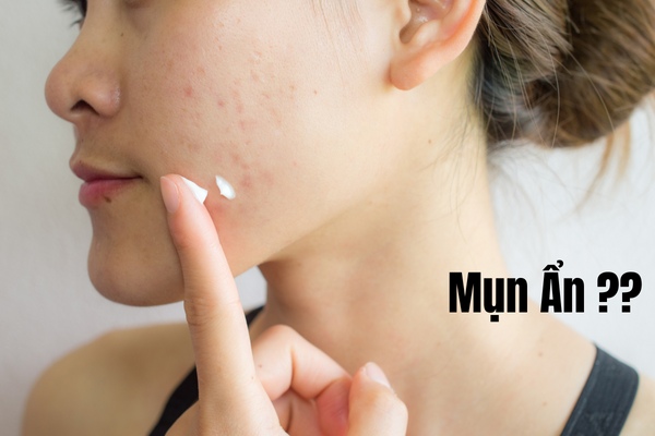 Mụn Ẩn: Cách Nhận Biết và Đối Phó!