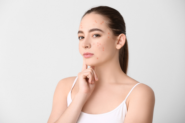 Tips Sử Lý Sẹo Thâm Sau Khi Nặn Mụn!