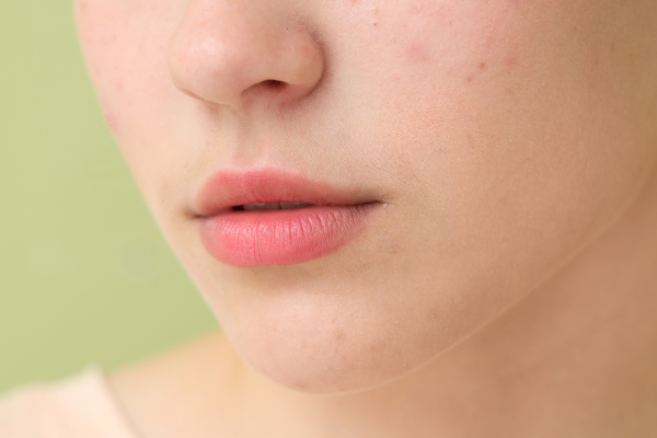 Làm Sao Để Dùng Retinol Mà Không Bị Kích Ứng?