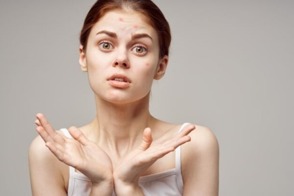 Mụn Nội Tiết và Những Lưu Ý Để Chăm Sóc Da Mụn?