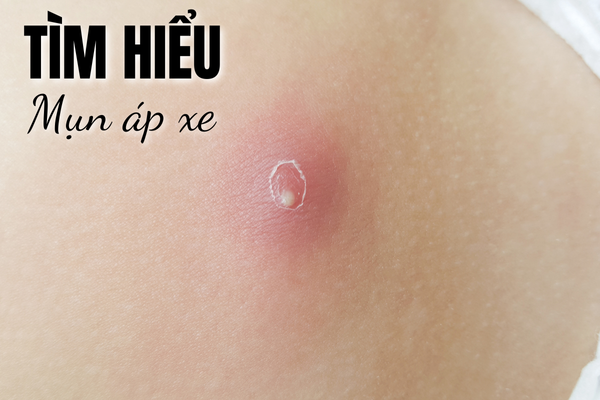 Mụn Áp Xe: Nguyên Nhân, Triệu Chứng và Giải Pháp Điều Trị Hiệu Quả