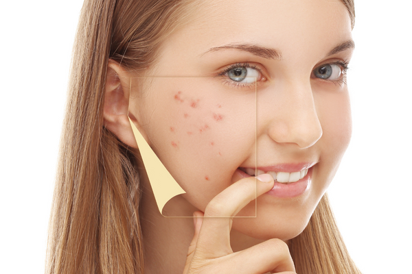 Phân Biệt Các Loại Mụn Và Các Cách Khắc Phục !