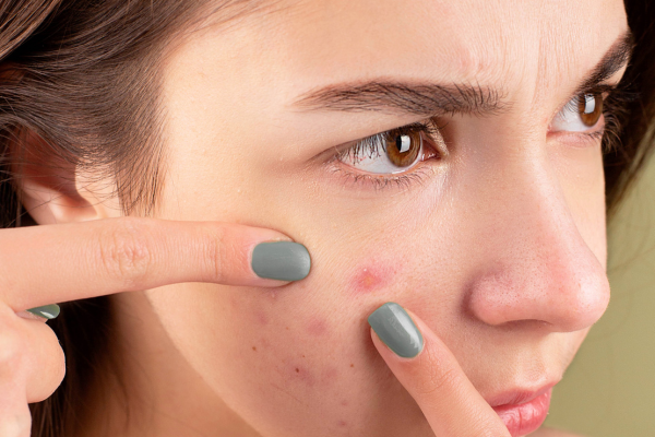 Có Nên Đi Lấy Nhân Mụn Ẩn, Uống Thuốc Khi Có Mụn Ẩn?