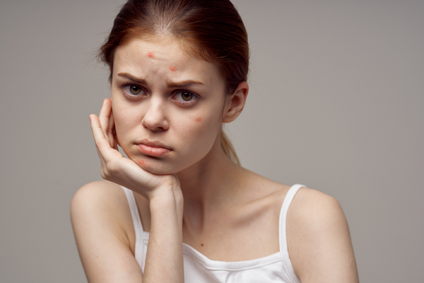 Chăm Sóc Da Mụn Nội Tiết Hiệu Quả?