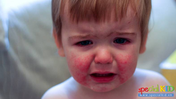 Cảnh báo bé bị dị ứng nổi mẩn đỏ cần phải làm gì đây?