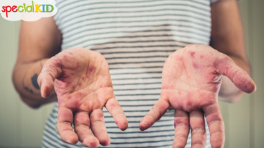 Bệnh tay chân miệng ở trẻ: Nhận biết và xử lý đúng cách