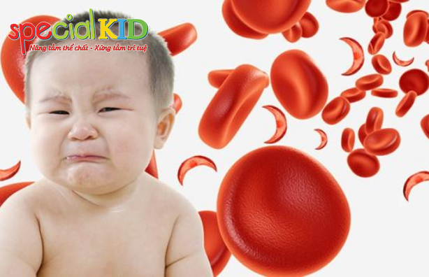 Dấu hiệu bệnh thiếu máu do thiếu sắt ở trẻ