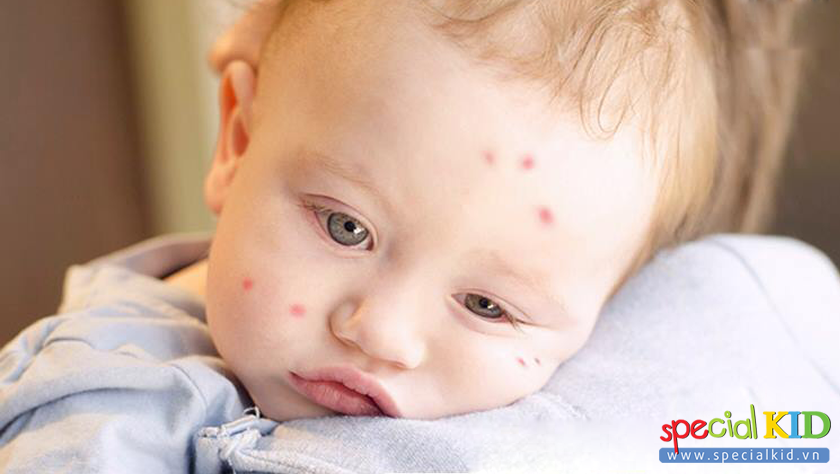 Nhận biết chính xác bệnh sốt xuất huyết gây nguy hiểm cho trẻ