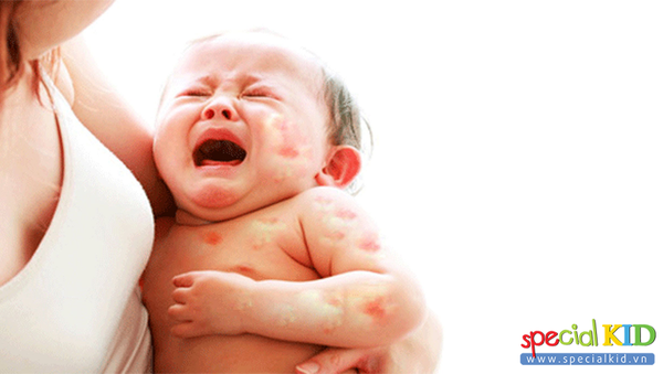 Trẻ sơ sinh bị dị ứng da mẹ nên biết