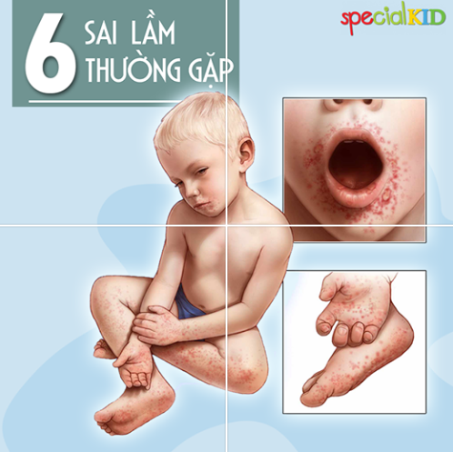 6 sai lầm nghiêm trọng khi con mắc tay chân miệng