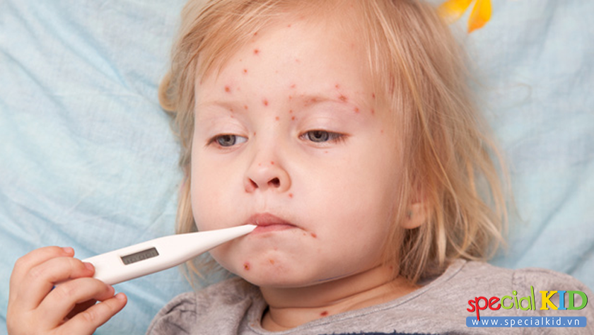 Dấu hiệu cảnh báo bệnh sốt xuất huyết ở trẻ em – Phát hiện sớm để tránh biến chứng nguy hiểm cho trẻ
