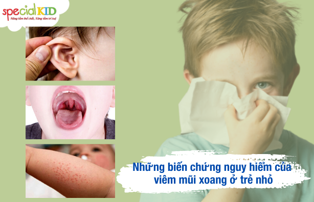 Biến chứng do viêm xoang mũi ở trẻ| Special Kid