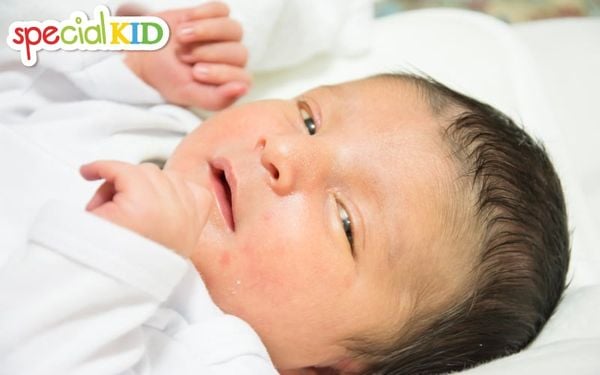 Vì sao trẻ sơ sinh bị vàng da | Special Kid