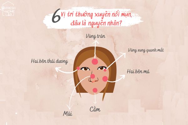 6 vị trí nổi mụn - Đâu là nguyên nhân?