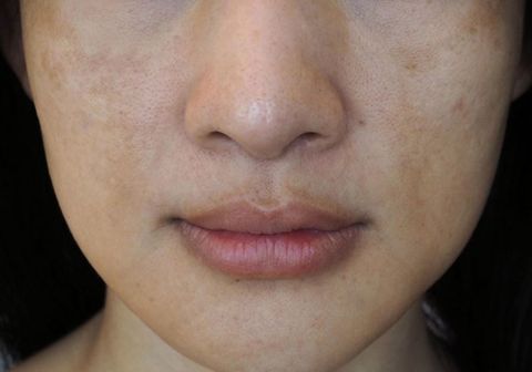 Làm Gì Khi Da Bị Xỉn Màu, Thiếu Sức Sống?