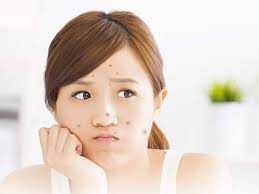 Da đang đẹp lại tự nhiên bị mụn – Vì sao và cách xử lý đúng?