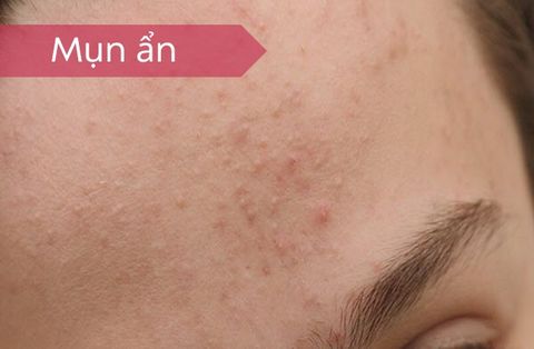 Cách Chăm Sóc Da Mặt Khi Bị Mụn Ẩn – Dịu Nhẹ Mà Hiệu Quả