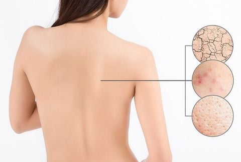 Tẩy Tế Bào Chết Body – Nên Dùng Hạt Hay AHA? Chọn Đúng, Da Mới Đẹp!