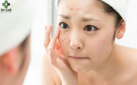 Skincare cho da dầu mụn nên lựa sản phẩm như thế nào đúng chuẩn?