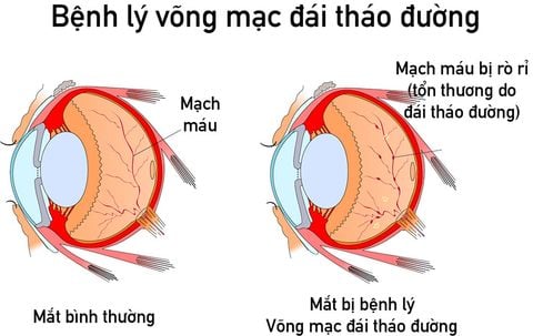 bien-chung-tieu-duong