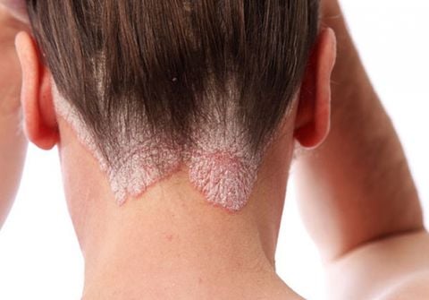 Bí Quyết Chữa Bệnh Chàm