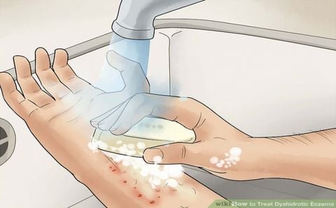 NHỮNG LƯU Ý KHI LÀM SẠCH DA MẮC BỆNH CHÀM