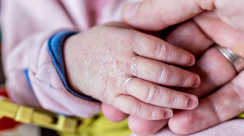 7 bệnh ngoài da thường gặp ở trẻ sơ sinh