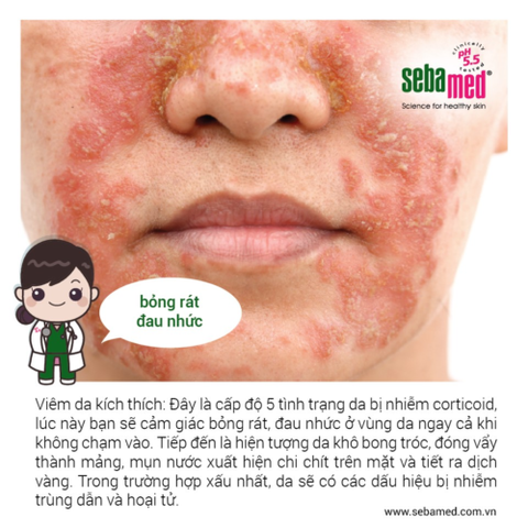 Những Dấu Hiệu Nhận Biết Da Nhiễm Corticoid