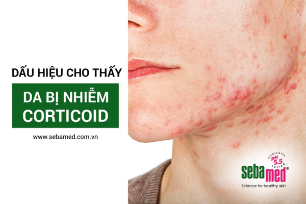 Dấu hiệu da nhiễm corticoid