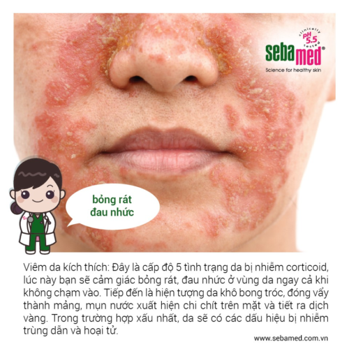 Dấu hiệu da nhiễm corticoid