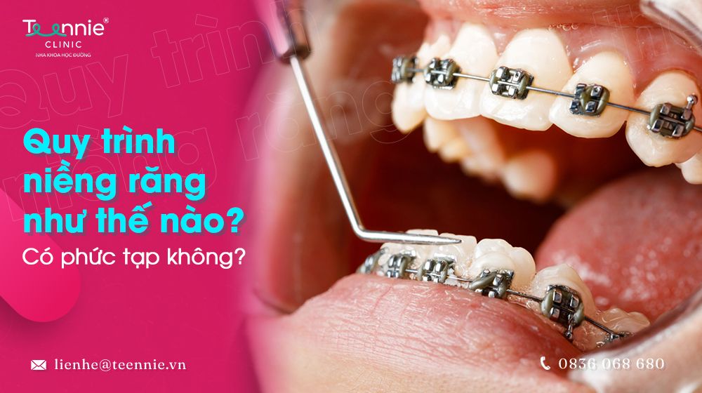 Quy trình niềng răng như thế nào, có phức tạp không?