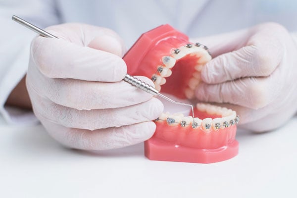 Tùy vào nhu cầu thẩm mỹ của mỗi cá nhân và mức độ răng sai lệch mà bác sĩ sẽ tư vấn các phương pháp niềng răng và giá phù hợp