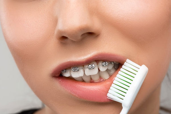 Những điều cần lưu ý trước và sau khi niềng răng để đảm bảo sức khỏe răng miệng