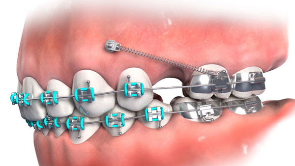 Thông tin về minivis trong niềng răng