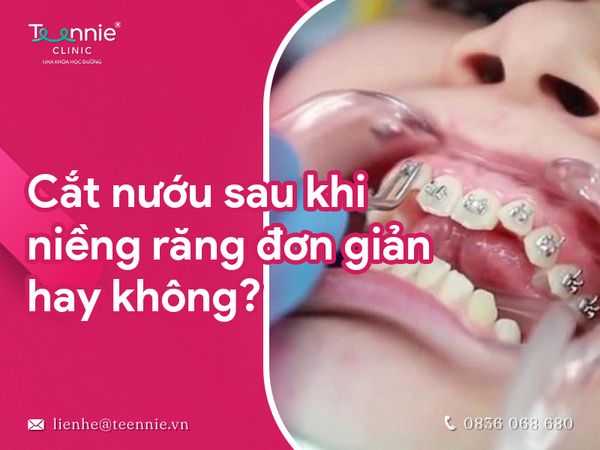 Vì sao thường cắt nướu sau khi niềng răng?