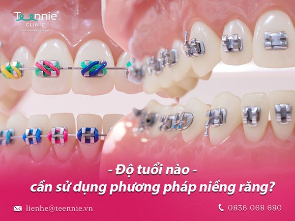 Chi phí niềng răng 5 triệu liệu có an toàn và hiệu quả?