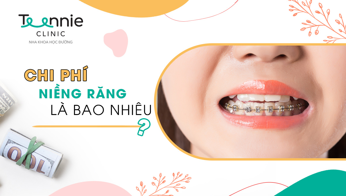 Chi phí niềng răng là bao nhiêu? Có đắt không?