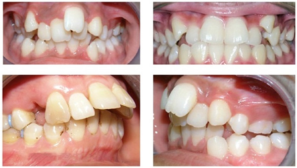 Tác hại của răng mọc không đều khiến bạn lo sợ