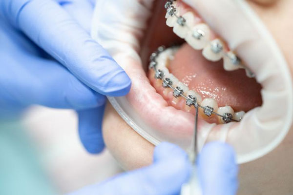 Thời gian đeo niềng răng sẽ từ 12 - 24 tháng và tùy thuộc vào nhiều yếu tố