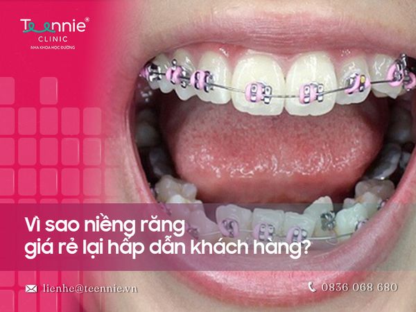 Giá niềng răng rẻ nhất tại Teennie có đi kèm chất lượng?
