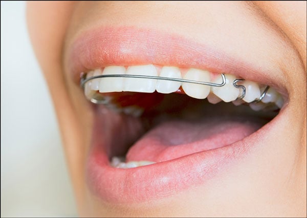 Thời gian đeo hàm duy trì sau khi niềng răng còn tùy thuộc vào tình trạng răng của từng người