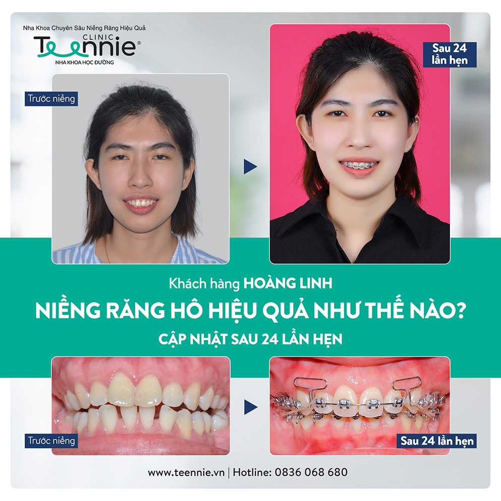 Khách hàng đăng ký niềng răng tại Teennie