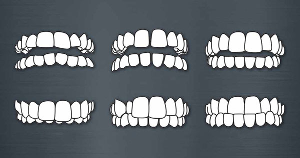 Dấu hiệu để nhận biết răng hàm bị lệch khớp cắn